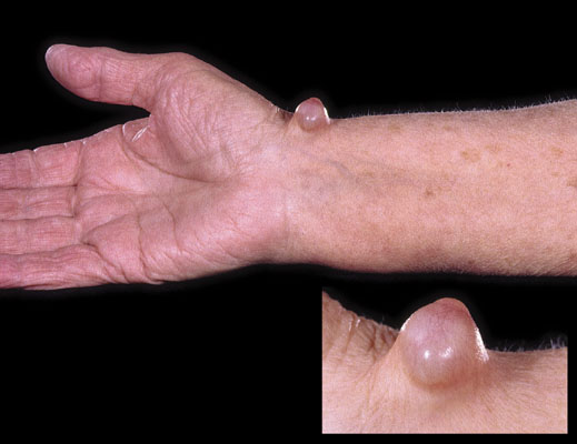 Ganglion cyst, wrist. Prize photograph. Institute of Medical Illustrators