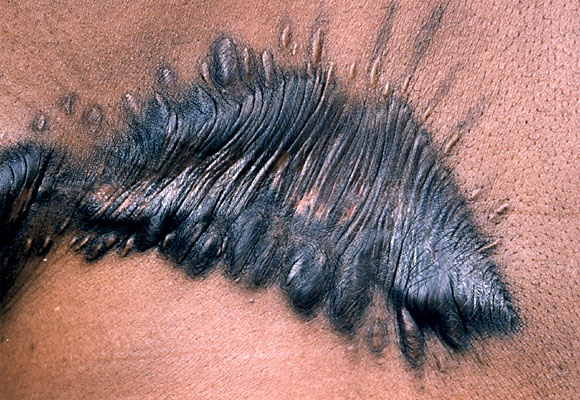 This is hypertrophic scar tissue formations bordering on keloid