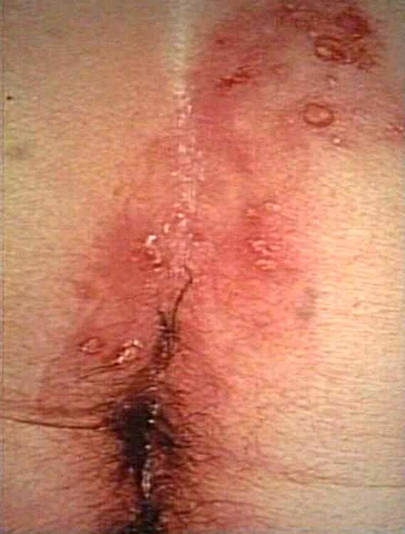 herpes anus pictures #11
