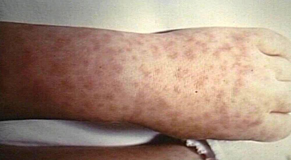 rocky mountain spotted fever precautions