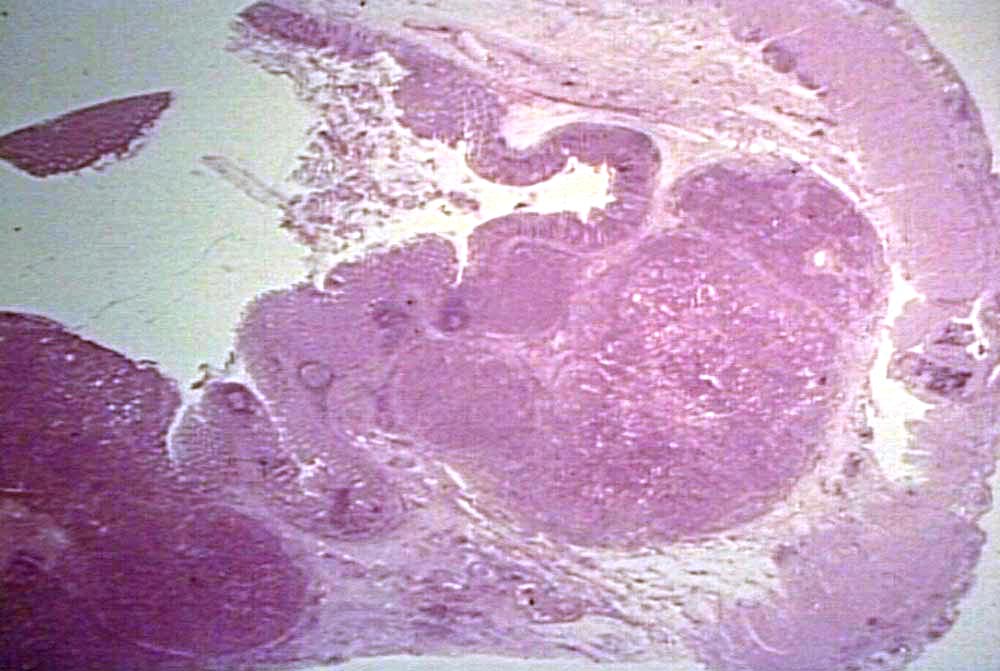 {08806} adenocarcinoma of colon; low-power shot shows it arising from the 