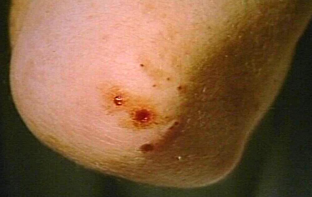 Red Rash On Inside Of Elbows - Doctor answers on HealthTap