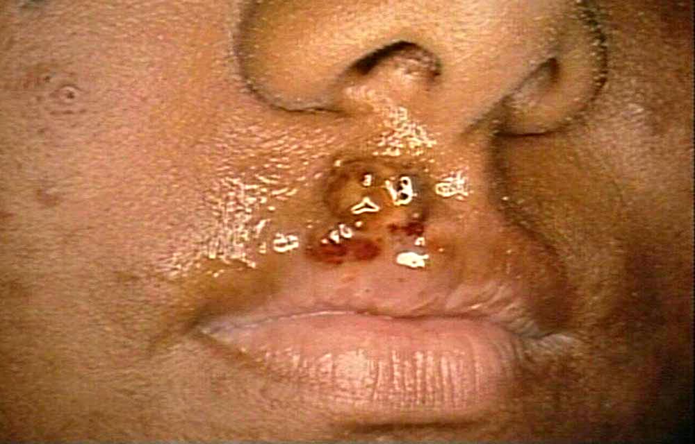 Oral Herpes Symptoms and Causes of Cold Sores