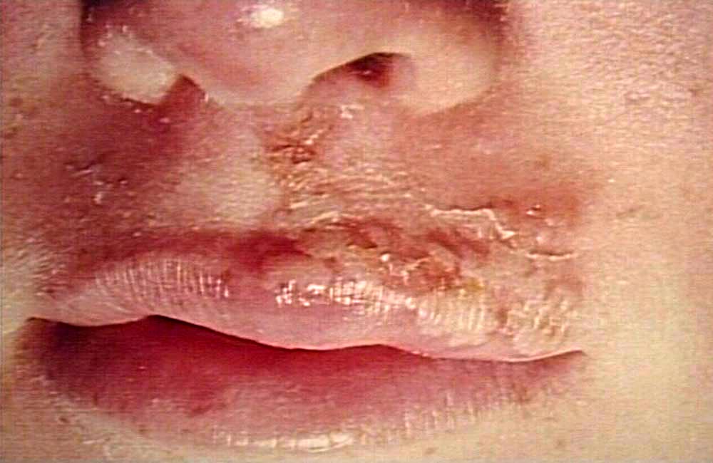 herpes genital photo. herpes genital warts.