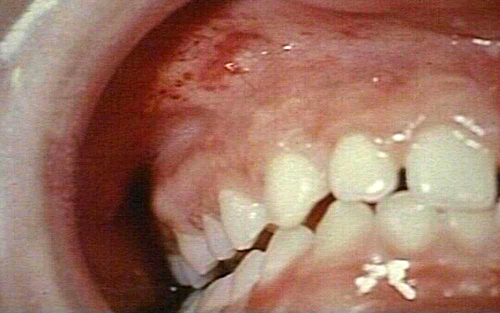 Oral Hemorrhage 17