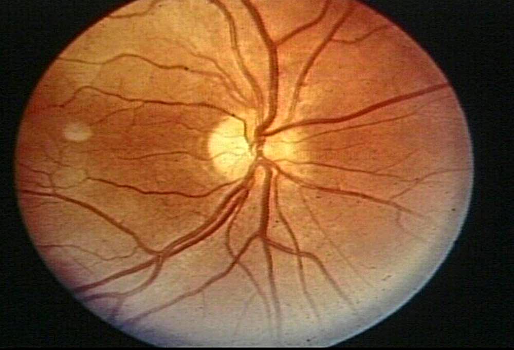 Optic Disk Blind Spot Optic Nerve Head Optic Papilla
