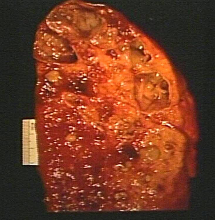 cystic fibrosis lungs. {26249} cystic fibrosis, lung