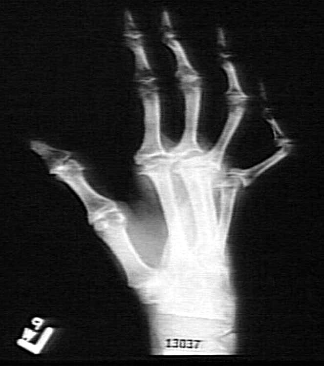 arthritis, x-ray
