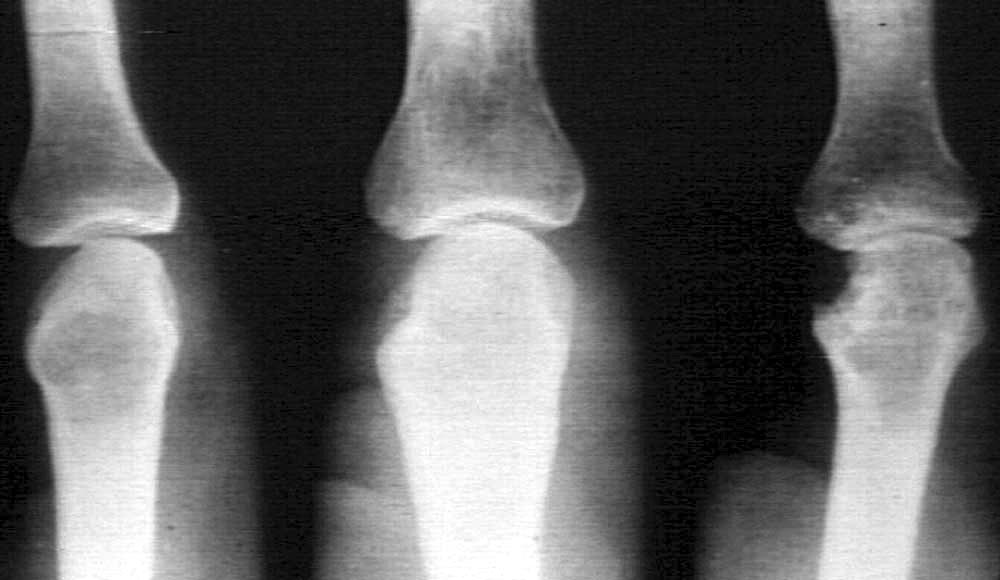 Osteoporosis X Ray. developed postmar Xray mar